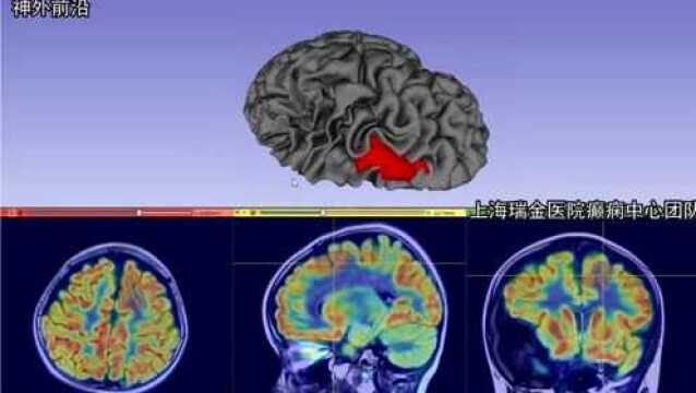 华科在线 | 专访瑞金医院刘强强:机器人3D结构光与SinoPlan软件的应用经验