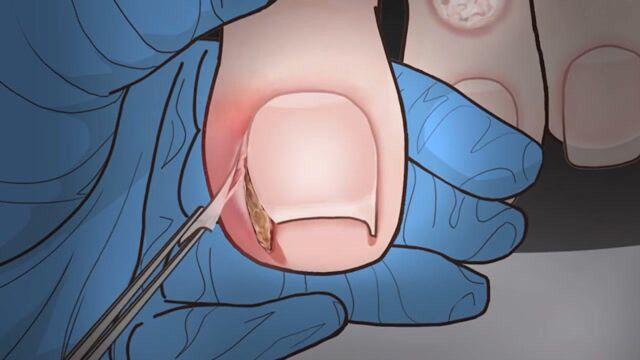 脚趾头出现严重的甲沟炎,修脚师傅耐心修剪,看完太解压