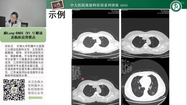 肺LungRADS(V1.1)解读及临床应用要点中大徐秋贞