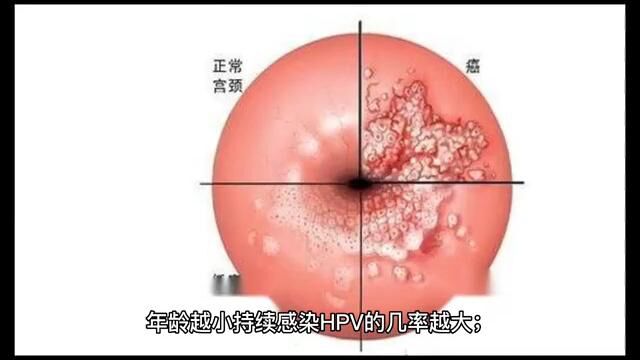 广州科大中医 HPV病毒主要是患宫颈癌的主要危险因素