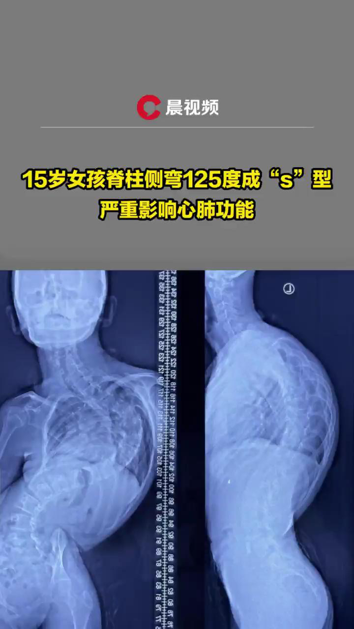 15岁女孩脊柱侧弯图片