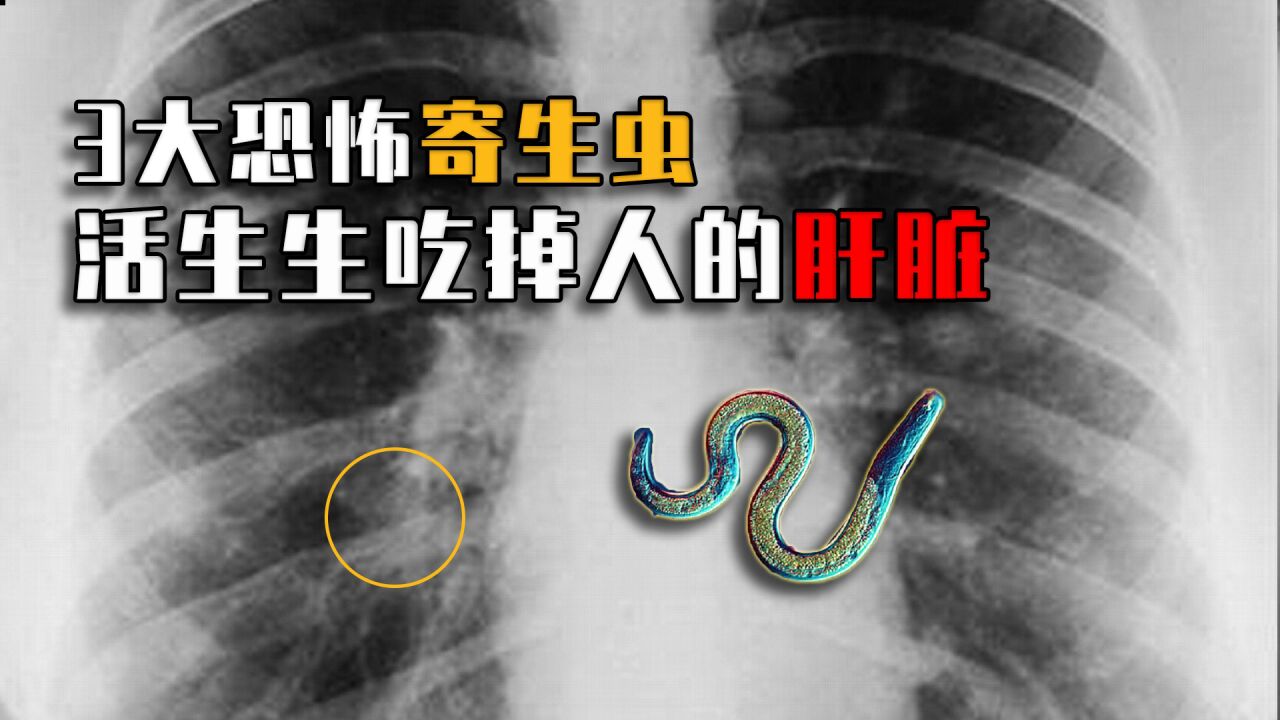 3大恐怖寄生虫:吃掉人的内脏,钻进人的眼睛,值得所有人警惕!