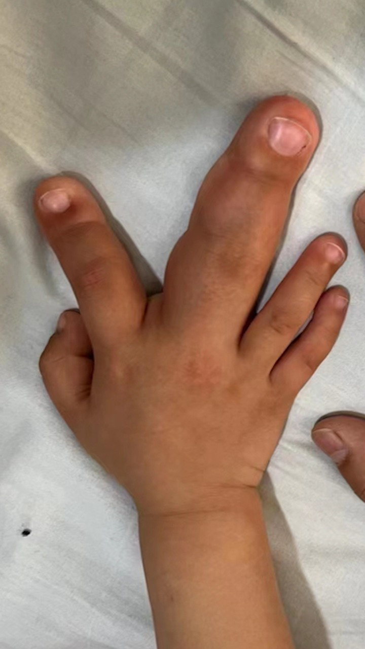 罕见巨指症!2岁男童手指比成年男子还粗