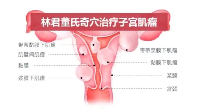 子宫肌瘤三大起因:一是炎,二是寒,三是气