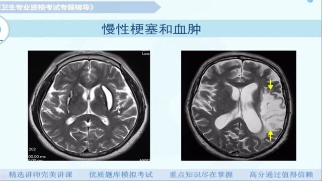 【放射医学(中级)】第八章神经系统及头颈部:脑出血&脑血管病变