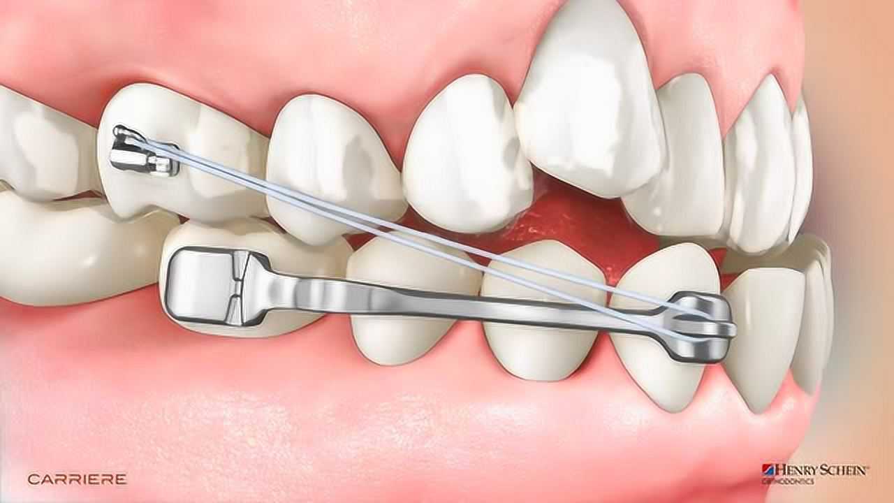地包天矫正过程,地包天通过牙齿矫正可以改变嘴型!_高清1080P在线观看平台_腾讯视频
