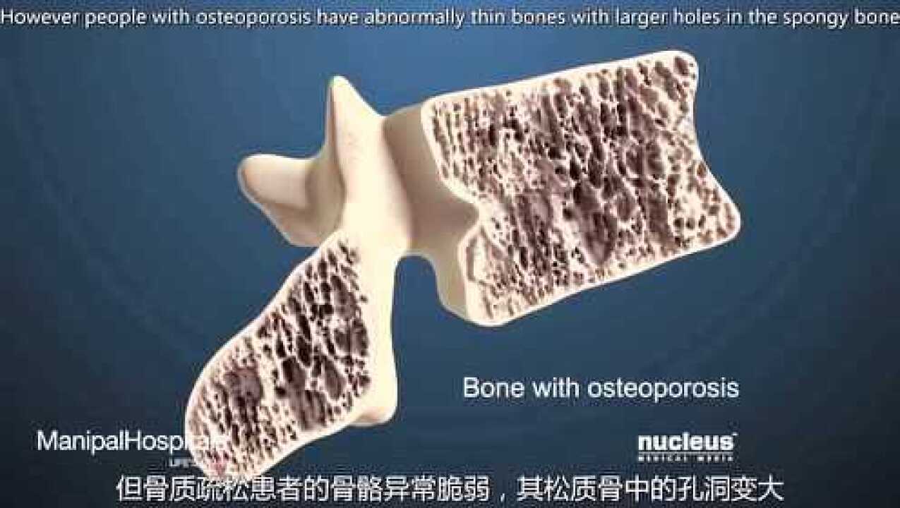 骨质疏松动画演示_高清1080P在线观看平台_腾讯视频