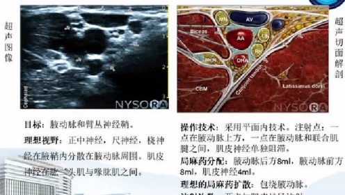 麻醉大讲堂第184讲:常用外周神经阻滞与超声介入解剖_腾讯视频