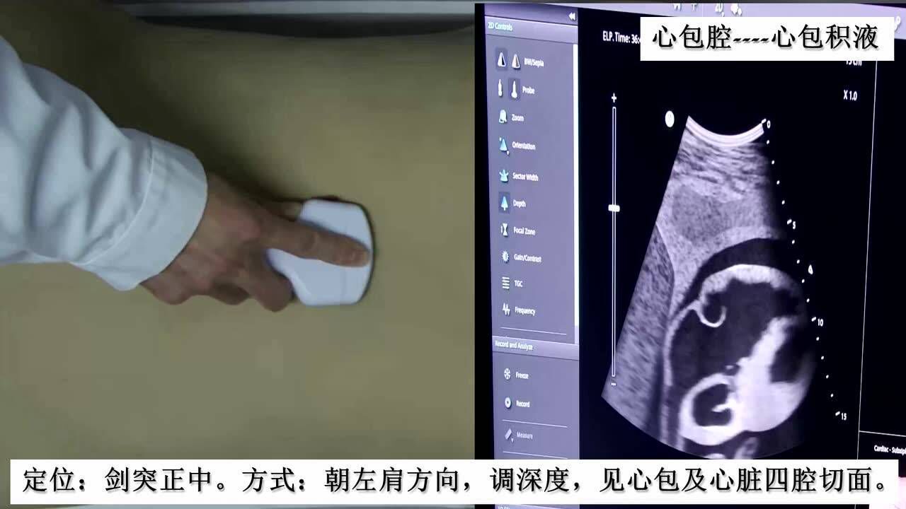 快速B超操作手法_腾讯视频