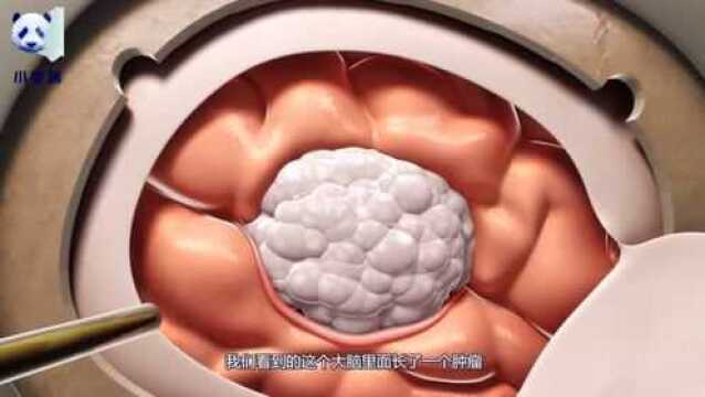 开颅手术如何开颅和缝制的?3D演示全过程,看的头皮发麻