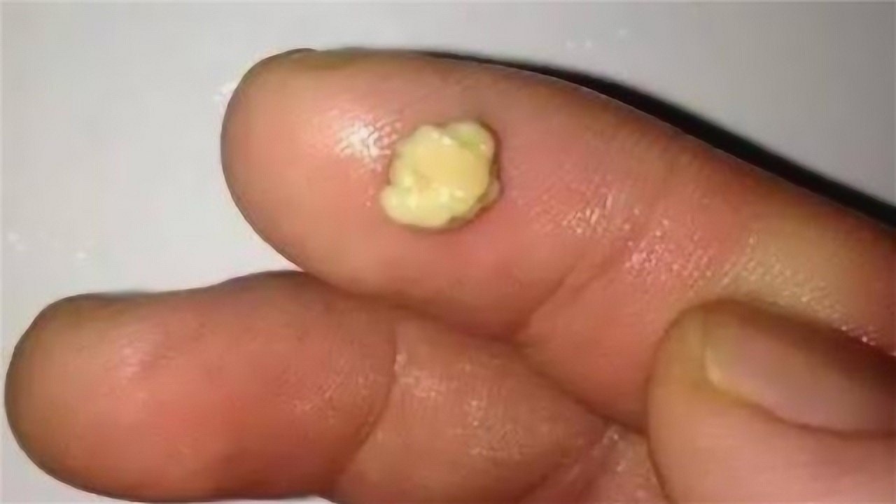 奇臭无比的扁桃体结石是这样长出来的看完整个人都不好了