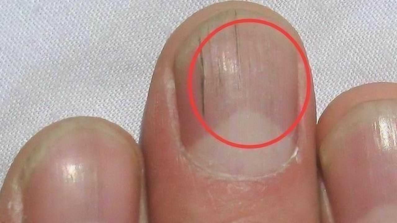 手指甲上长出竖纹是怎么回事?可能和这4点有关,别再瞎猜了!
