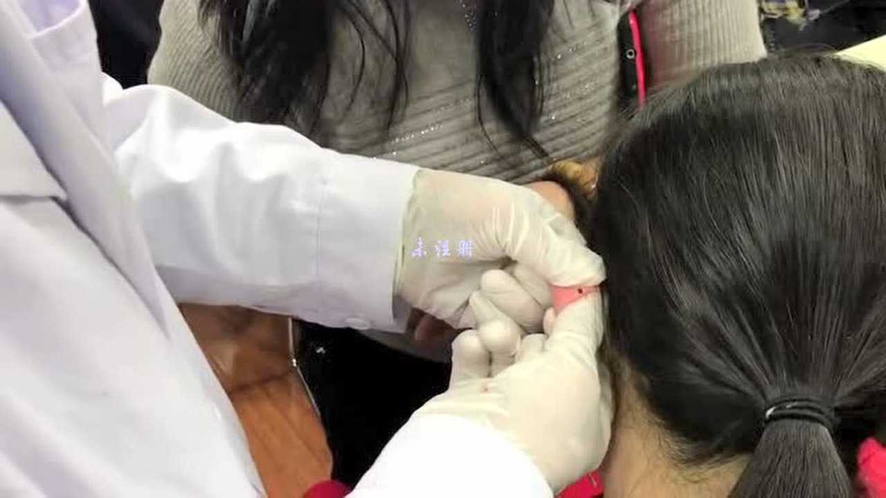 中医针灸放血耳背放血治疗面瘫发烧降压_腾讯视频