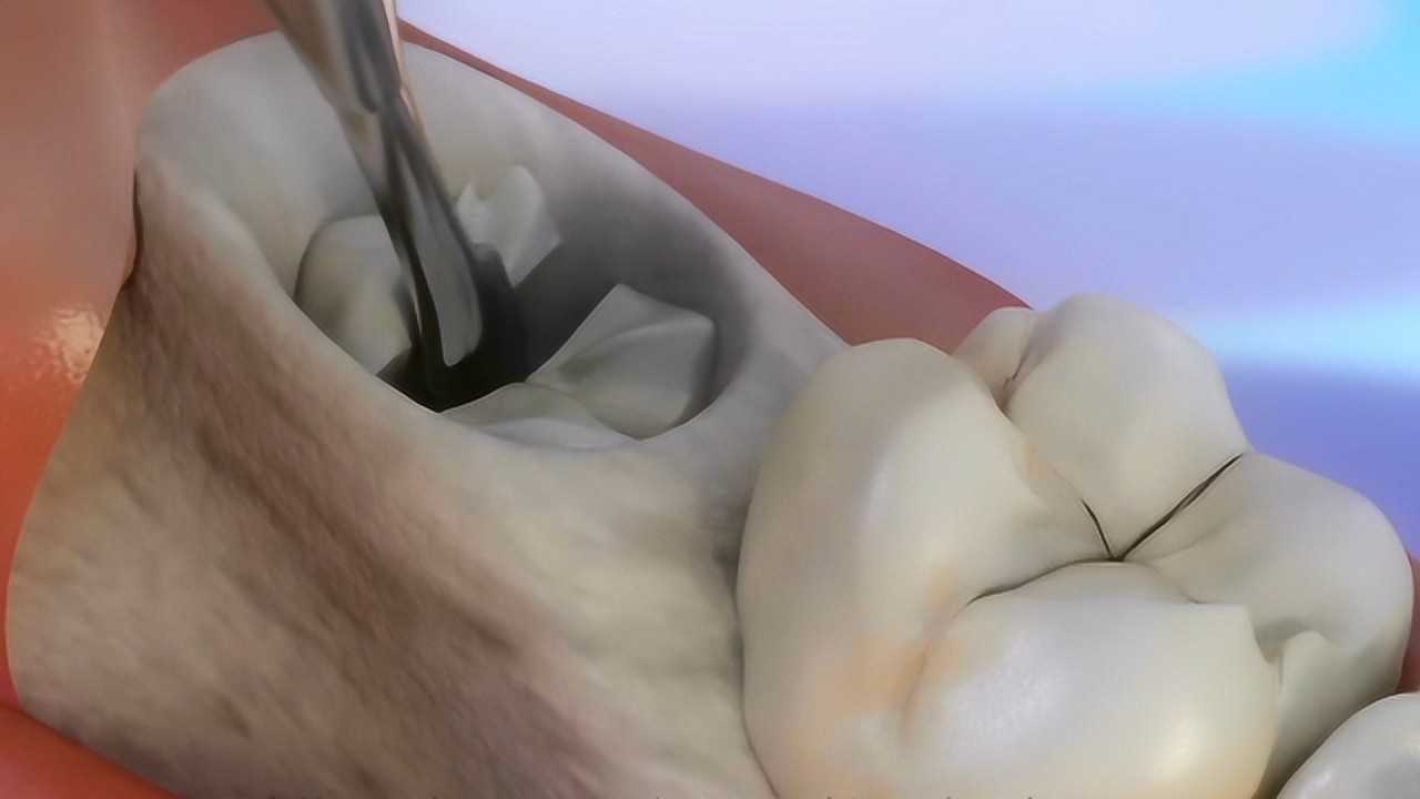 3d动画演示补牙全过程看着都觉得腮帮子疼还有一点小过瘾