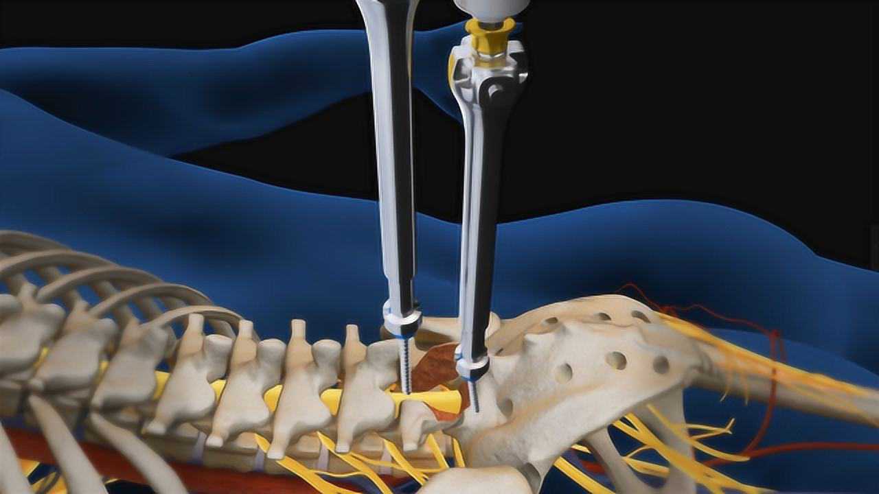 3d动画演示腰间盘突出切除手术,吓得我赶紧挺直了腰板