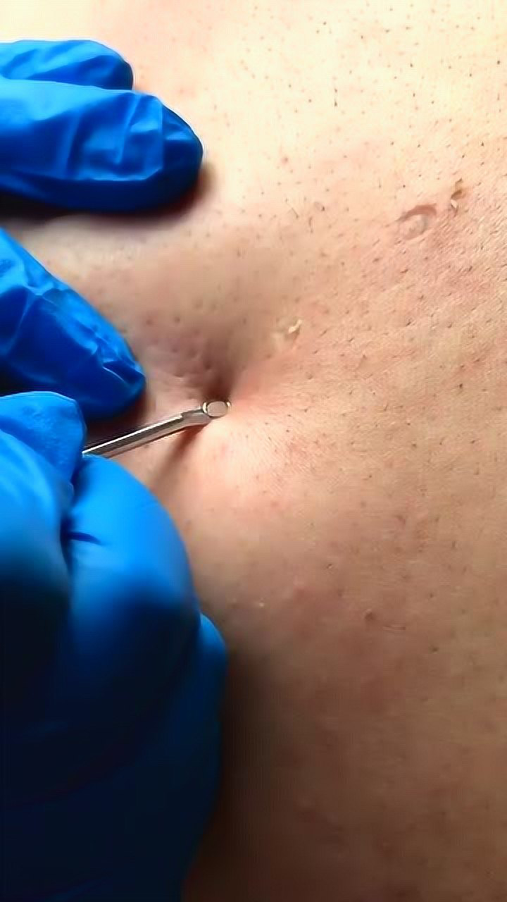 刚刚形成的螨虫赶快挤出来过程真是太解压了看着真酸爽