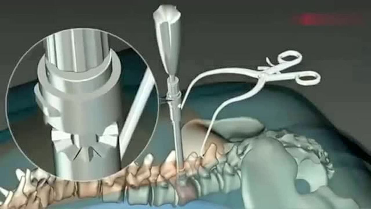 人的脊椎变形如何矫正的看完这手术过程真佩服现代医学