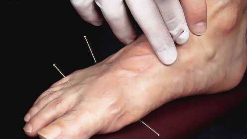 较真 | 足底放血可以治疗脑溢血?