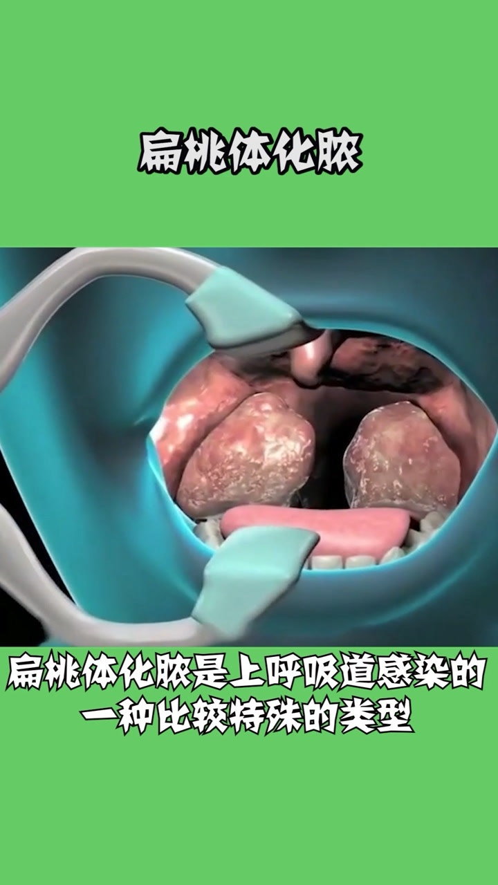 扁桃体化脓切除手术过程