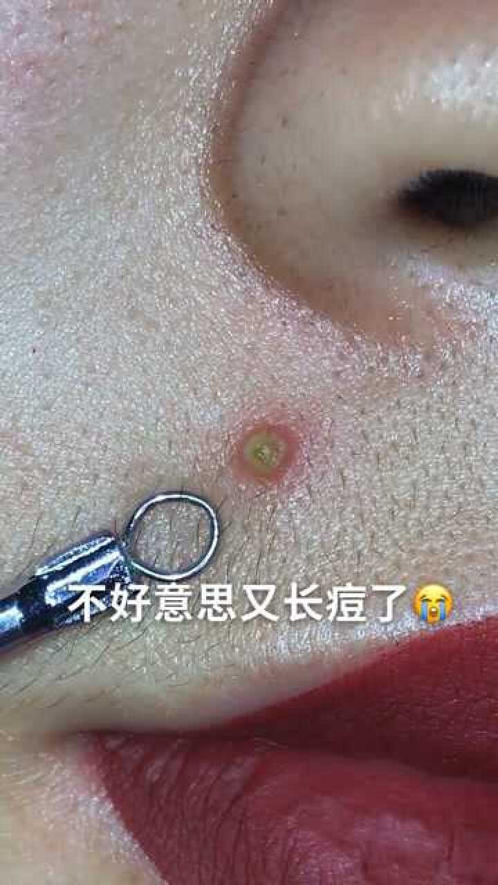 正确处理脓包痘痘 不留痘印