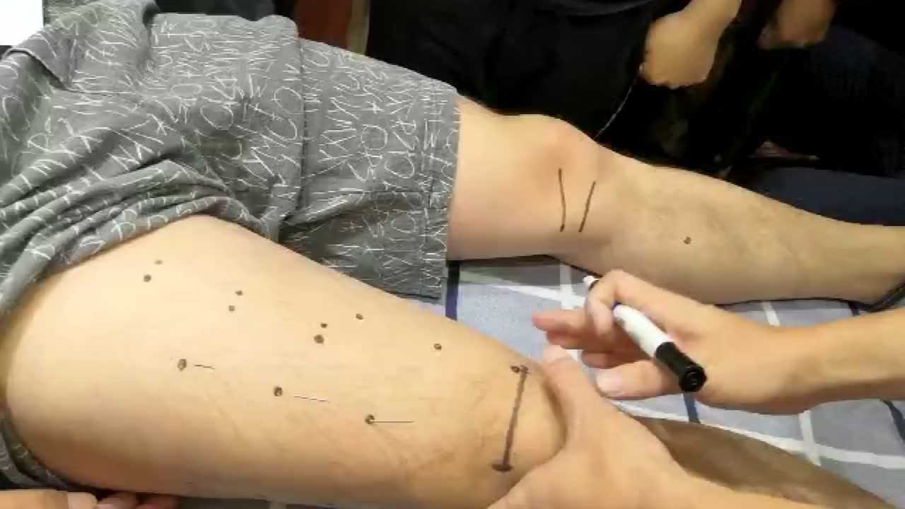 针灸董氏奇穴上三皇的取穴方法治疗癫痫的配穴方法