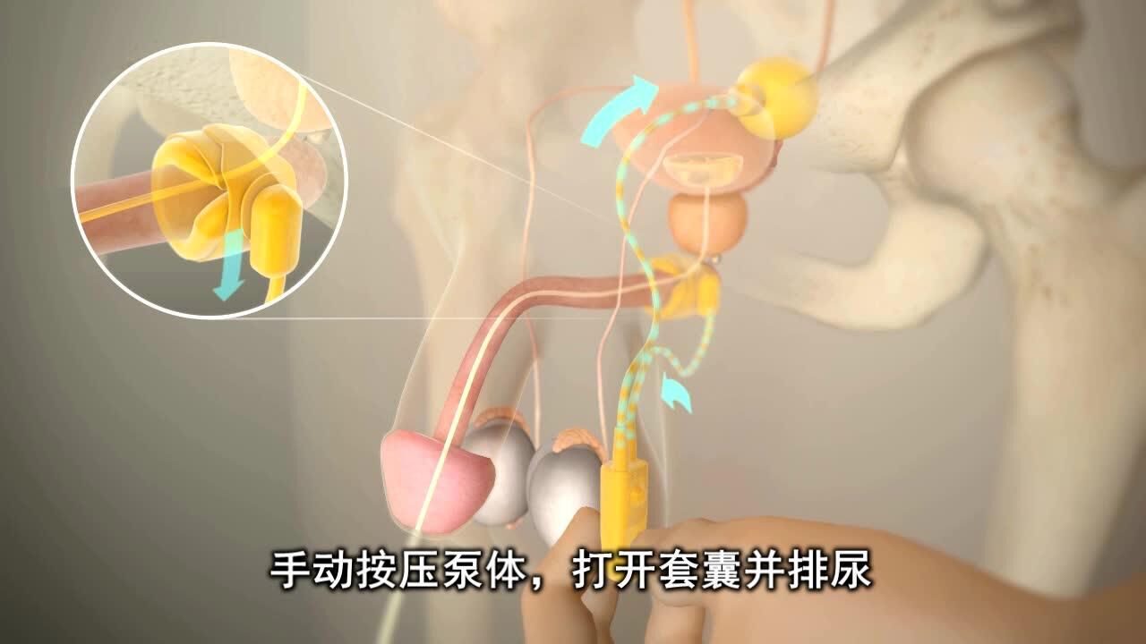 人工括约肌手术视频.mp4