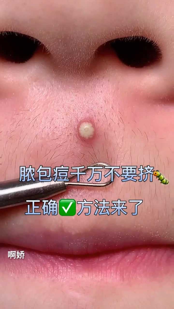 真确清理脓包型痘痘