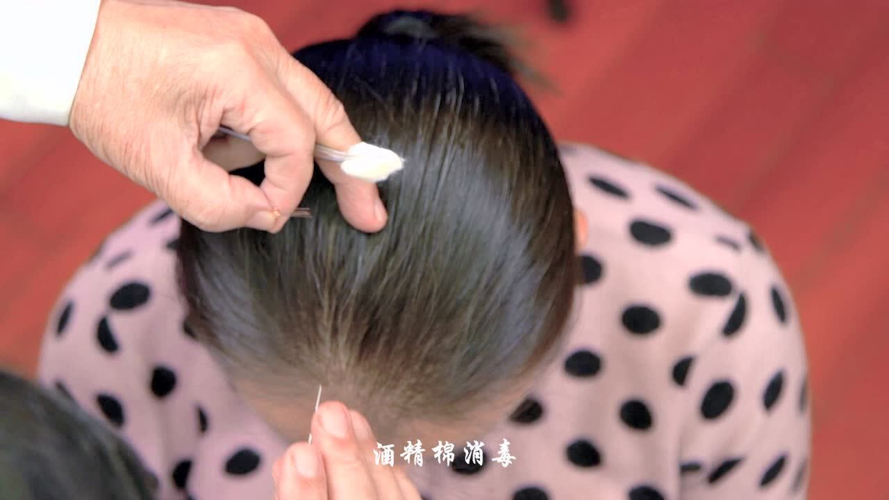 张仁特色针刺技法23平扬刺法