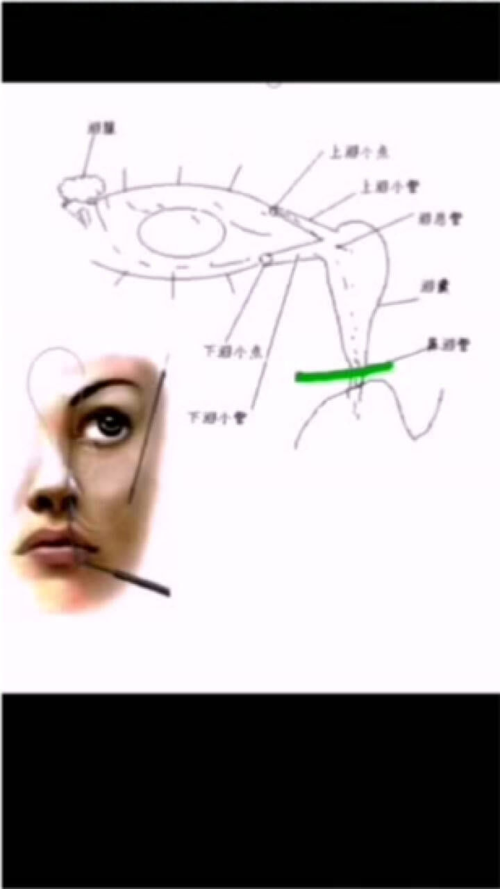 泪道堵塞时间长，有脓性分泌物怎么办？_高清1080P在线观看平台_腾讯视频
