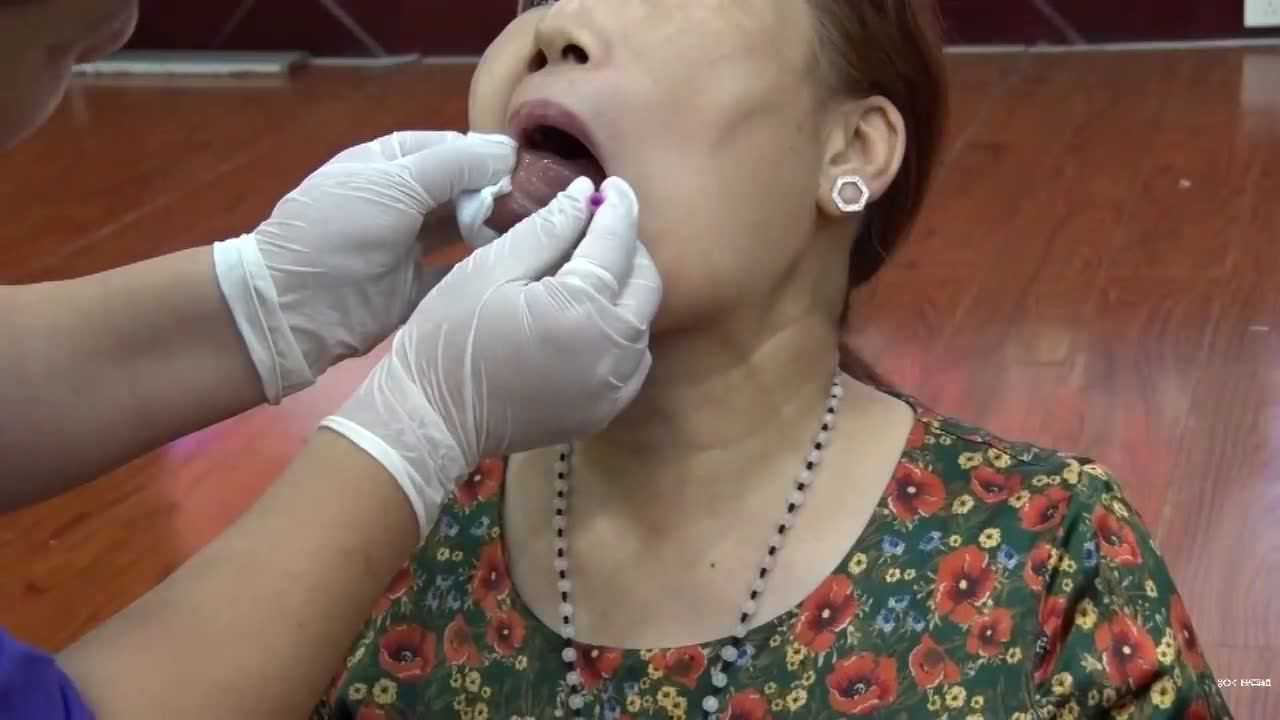 董氏奇穴舌头点刺法