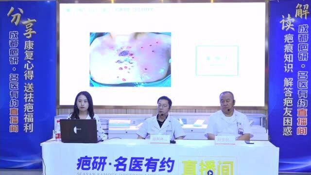 成都疤研疤痕医院治疗怎么样?环钻技术有效运用各种疤痕修复