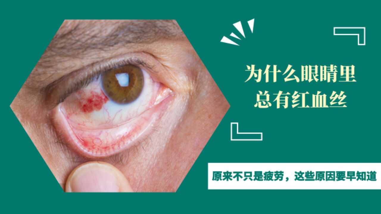 为什么眼睛里总有红血丝？原来不只是疲劳，这些原因要早知道_腾讯视频