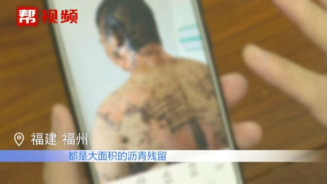 沥青竟“从天而降” 男子全身大面积严重烫伤