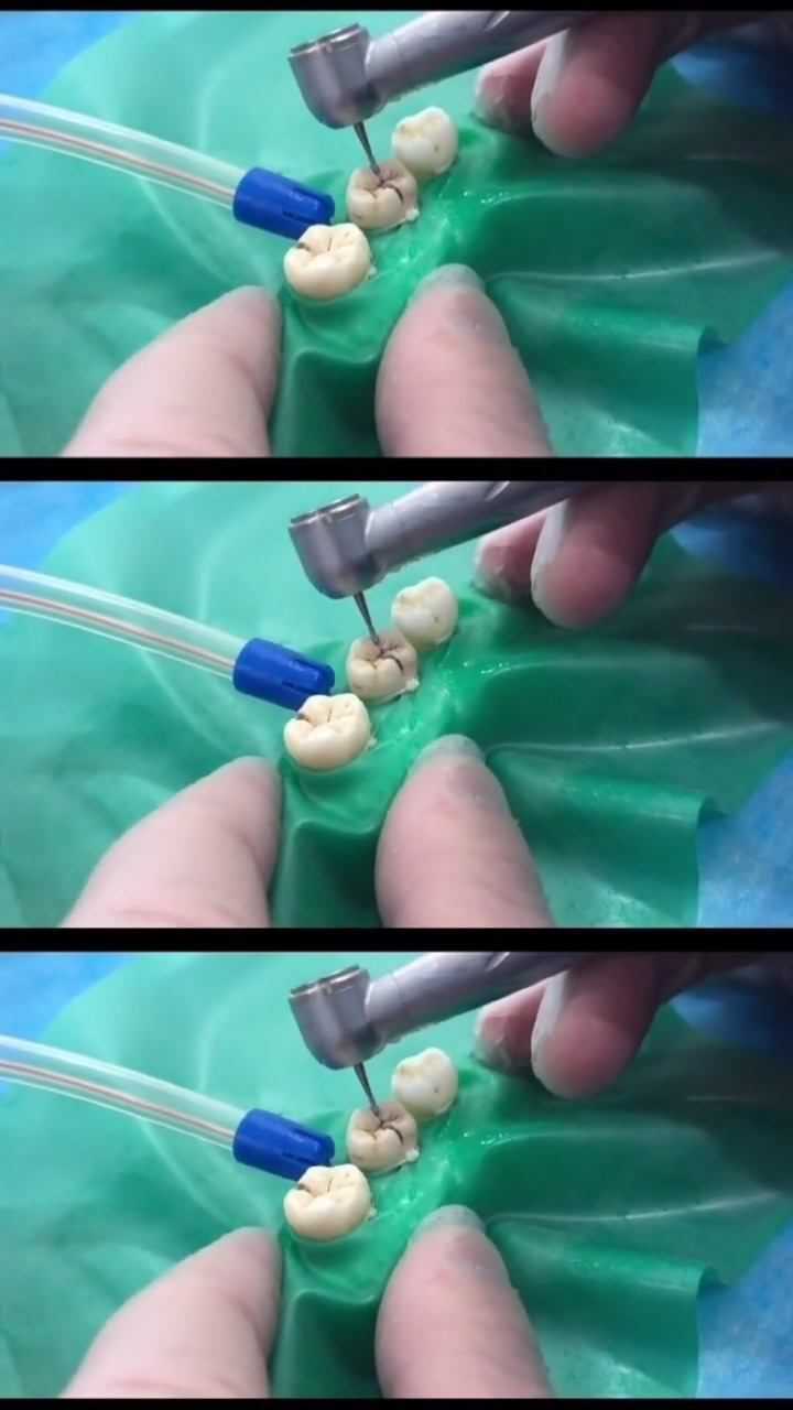 补牙过程是怎样的