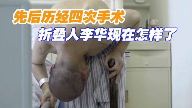 身体弯曲180度,历经四次手术后,“折叠人”李华现在怎么样了?