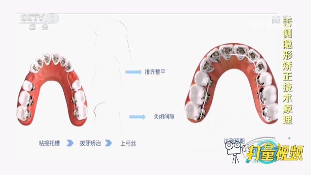 新型牙齿矫正技术,矫治效果更精准美观,为患者带来福音