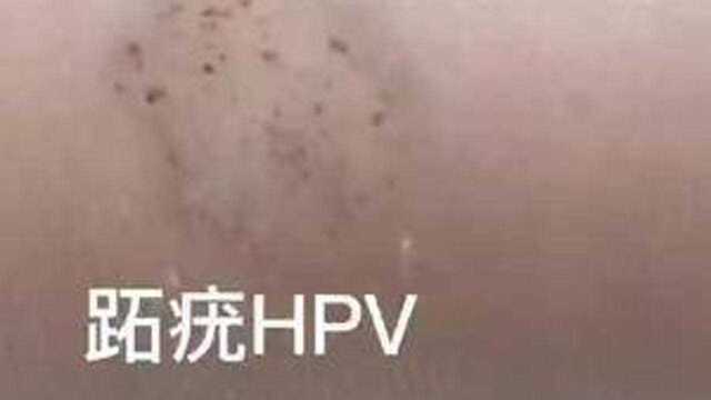 一次搞定血胞刺一瓶可以涂抹1000多个跖疣.