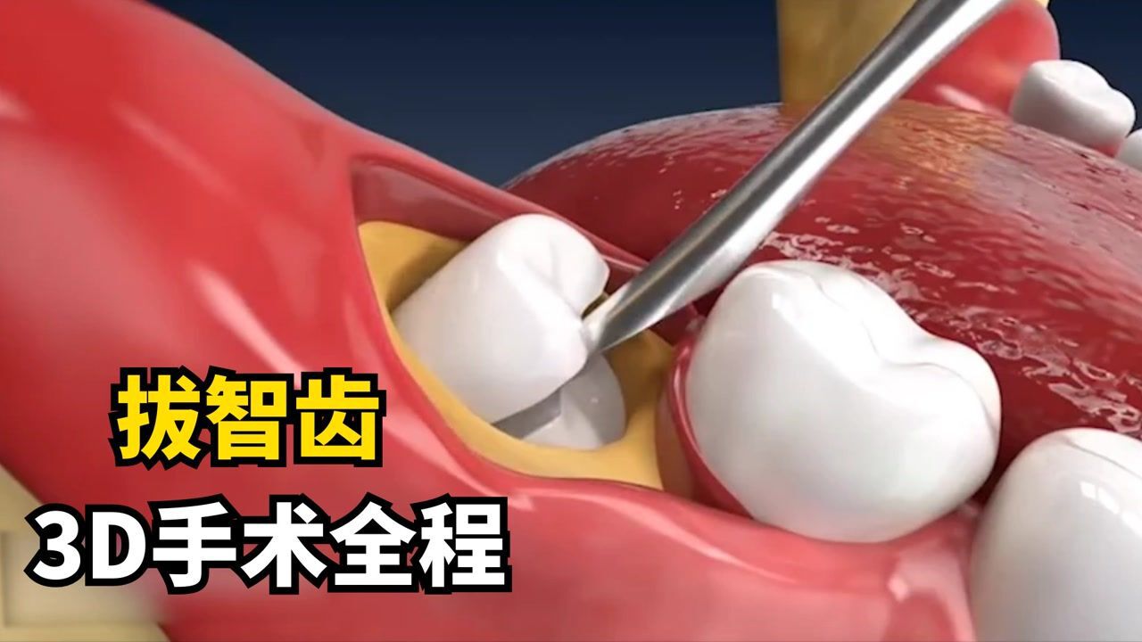 你有过长智齿的经历吗？一分钟演示手术全过程，看完牙齿隐隐作痛_高清