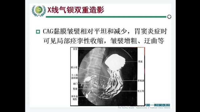 消化系统疾病胃炎