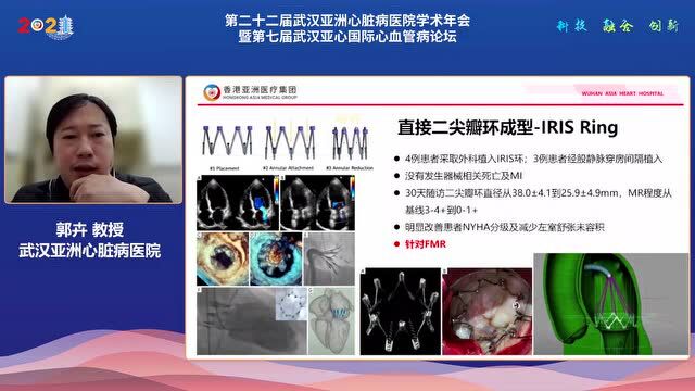 学术分享 | 郭卉教授:继发性二尖瓣反流的病因及介入治疗进展