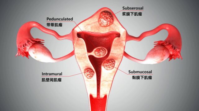 【RF Medical爱尔富】GYN RFA 3D Video 妇科射频消融 【子宫肌瘤 & 子宫内膜】