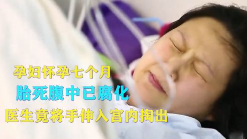 孕妇怀孕七个月，胎死腹中已腐化，医生竟将手伸入宫内掏出