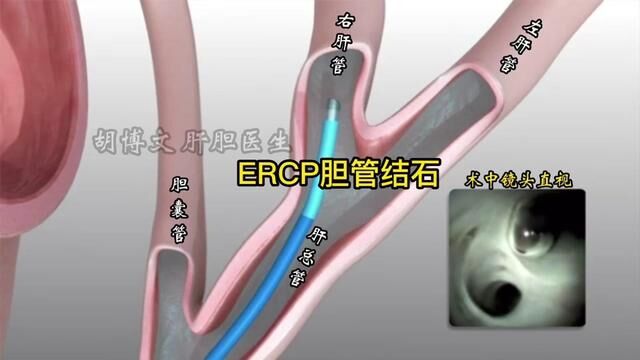 有朋友咨询ERCP,全称:经内镜胰胆管造影术.今天带大家清晰了解一下.