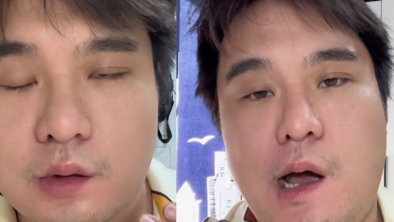 男子感染新冠面瘫了!嘴歪脸斜闭眼有问题,发出感慨提醒大伙注意事项