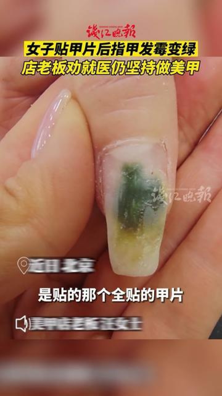 绿霉菌指甲图片图片