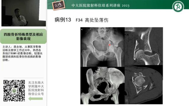 四肢骨折特殊类型及影像表现中大龚永驰