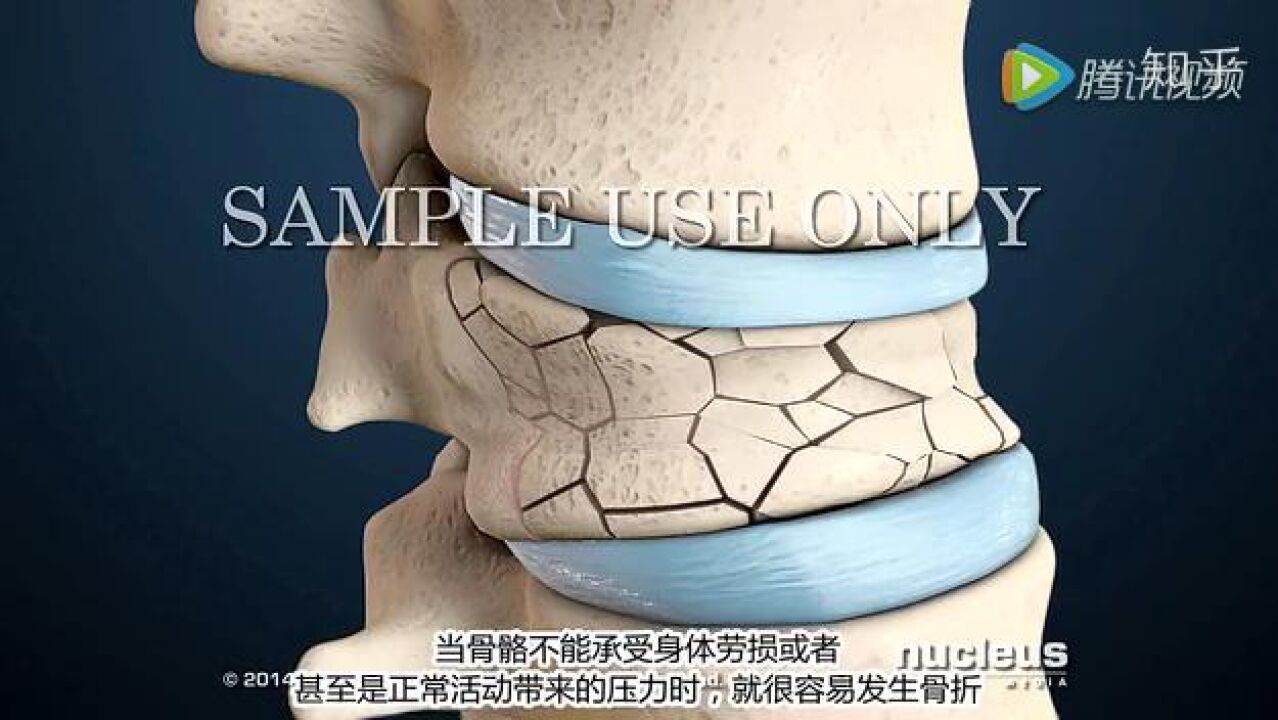 3D动画丨带你了解人体的骨质疏松_高清1080P在线观看平台_腾讯视频