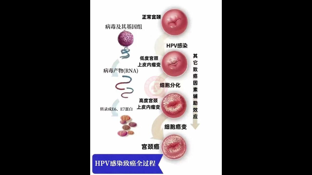 hpv感染致癌全过程 广州科大中医医院