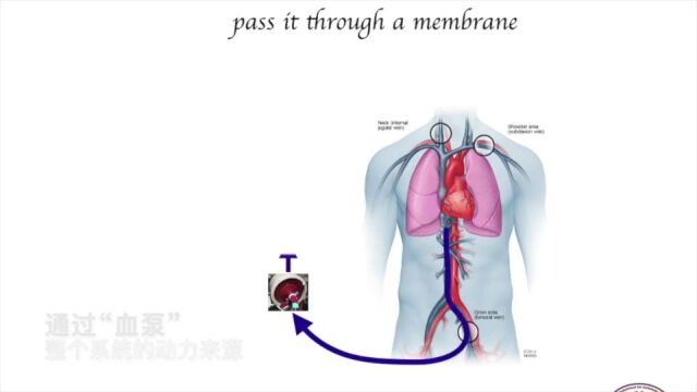 解密ICU的终极武器ECMO