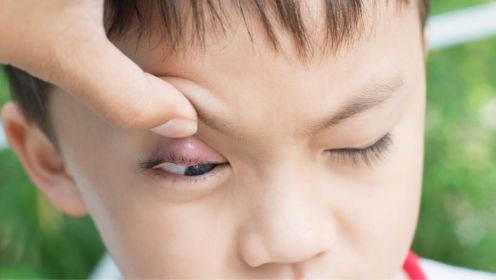 霰粒肿和麦粒肿都是在眼皮上长“痘痘”，两者有何区别呢？